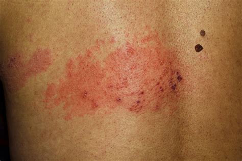 People often feel pain, itching, or tingling in the area 1-5 days before the rash appears. . Stages of shingles pictures